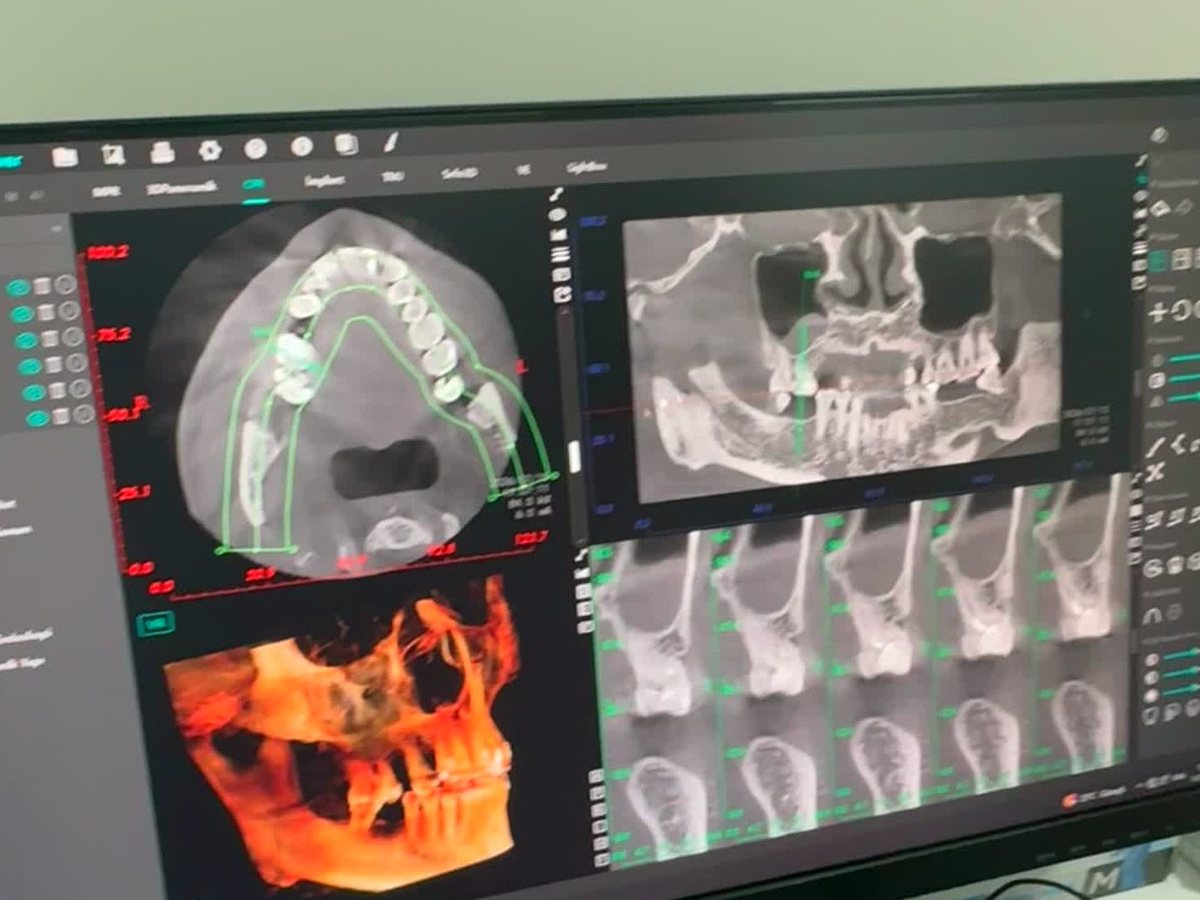 3D tomography planning for a full-arch implant case