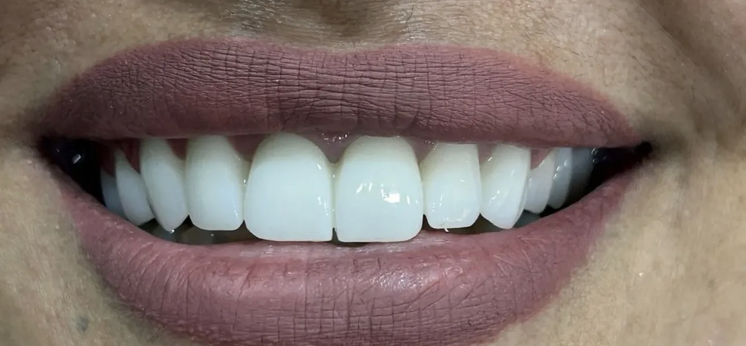 After treatment at İ-Klinik