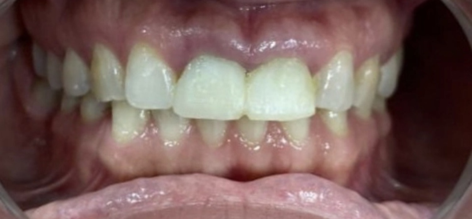 Before treatment at İ-Klinik
