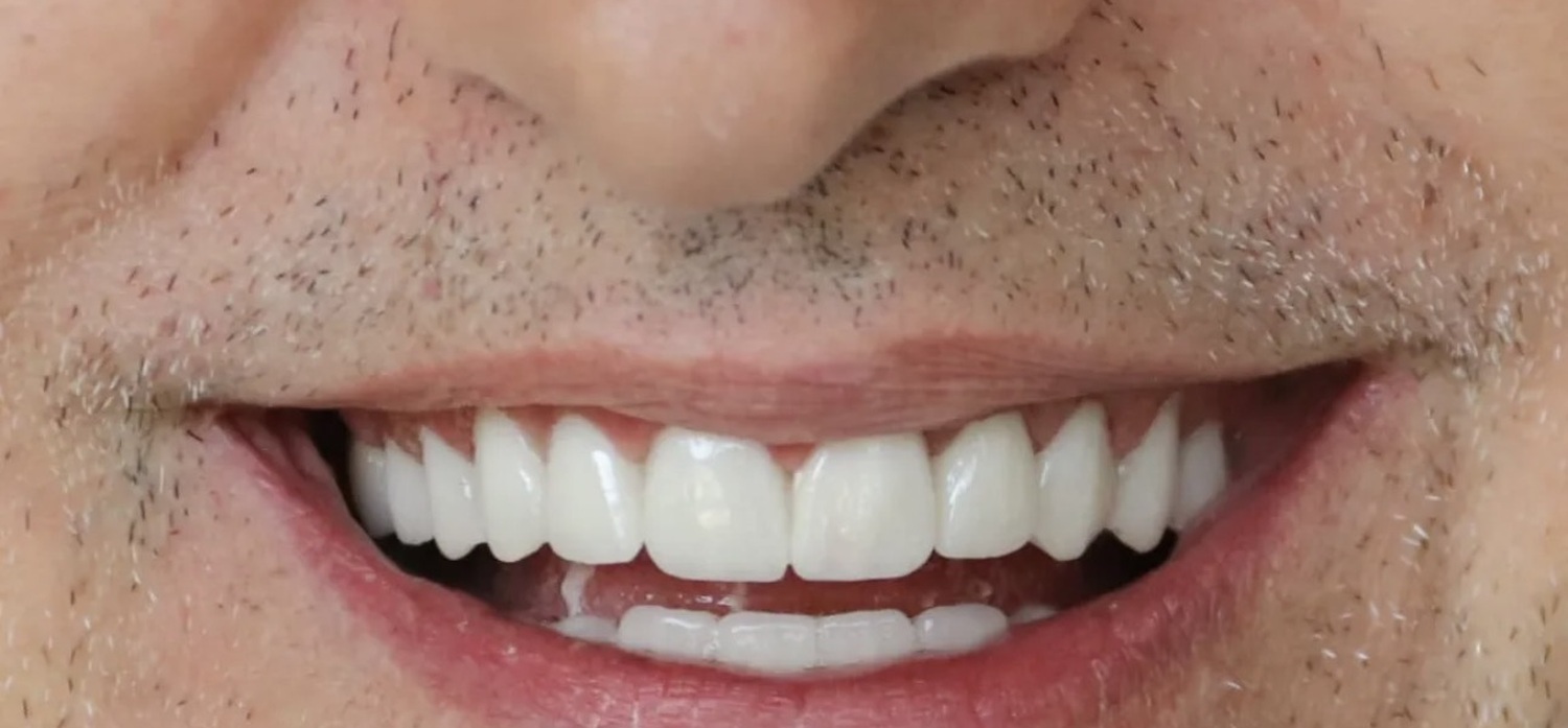After treatment at İ-Klinik