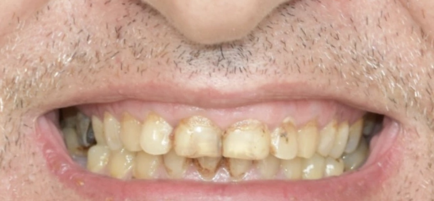 Before treatment at İ-Klinik