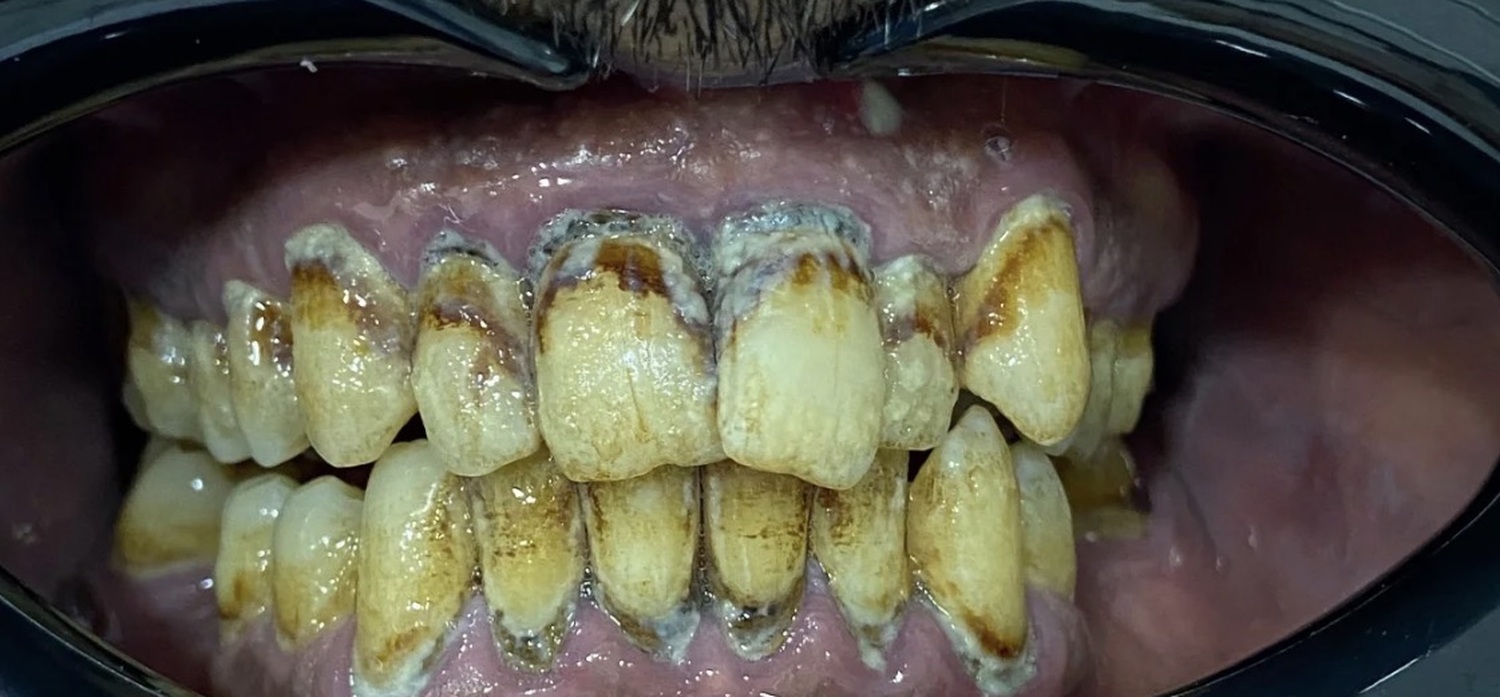 Before treatment at İ-Klinik