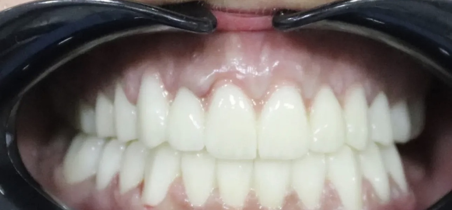 After treatment at İ-Klinik