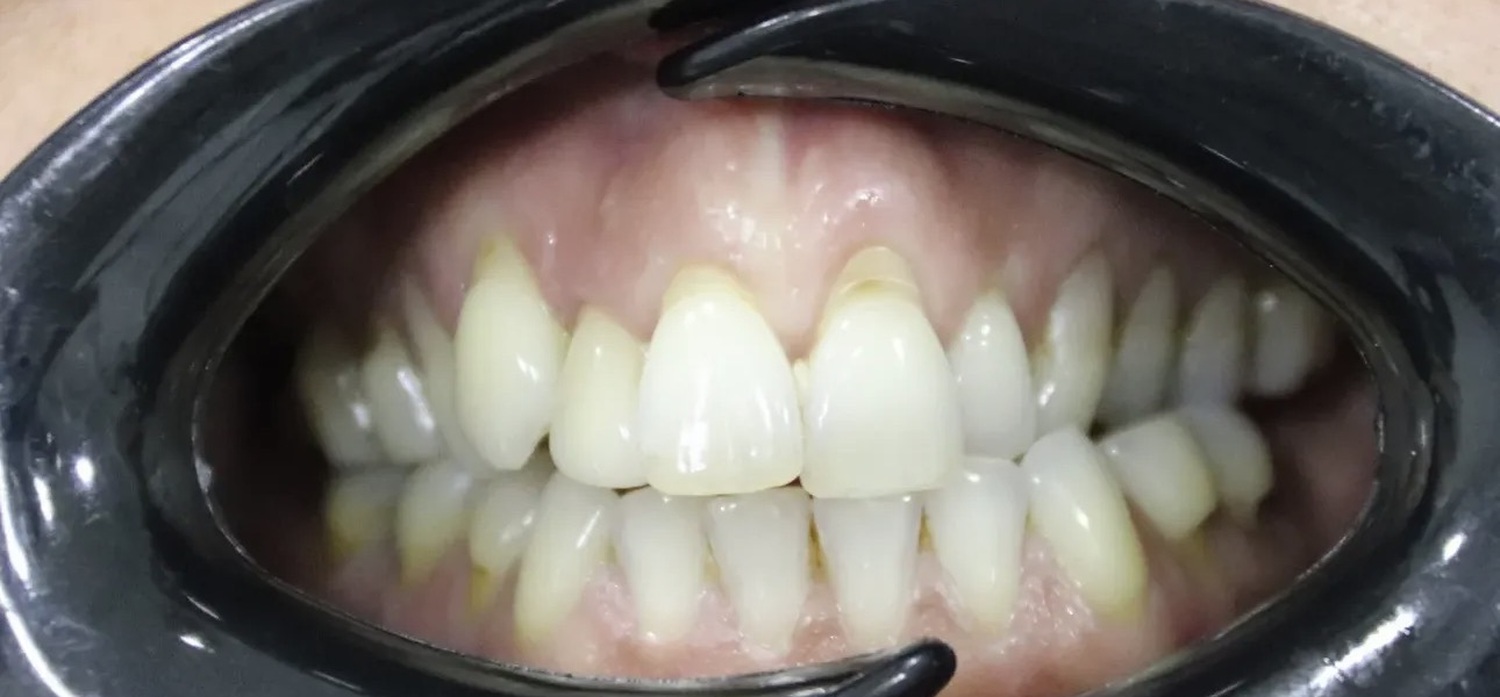 Before treatment at İ-Klinik