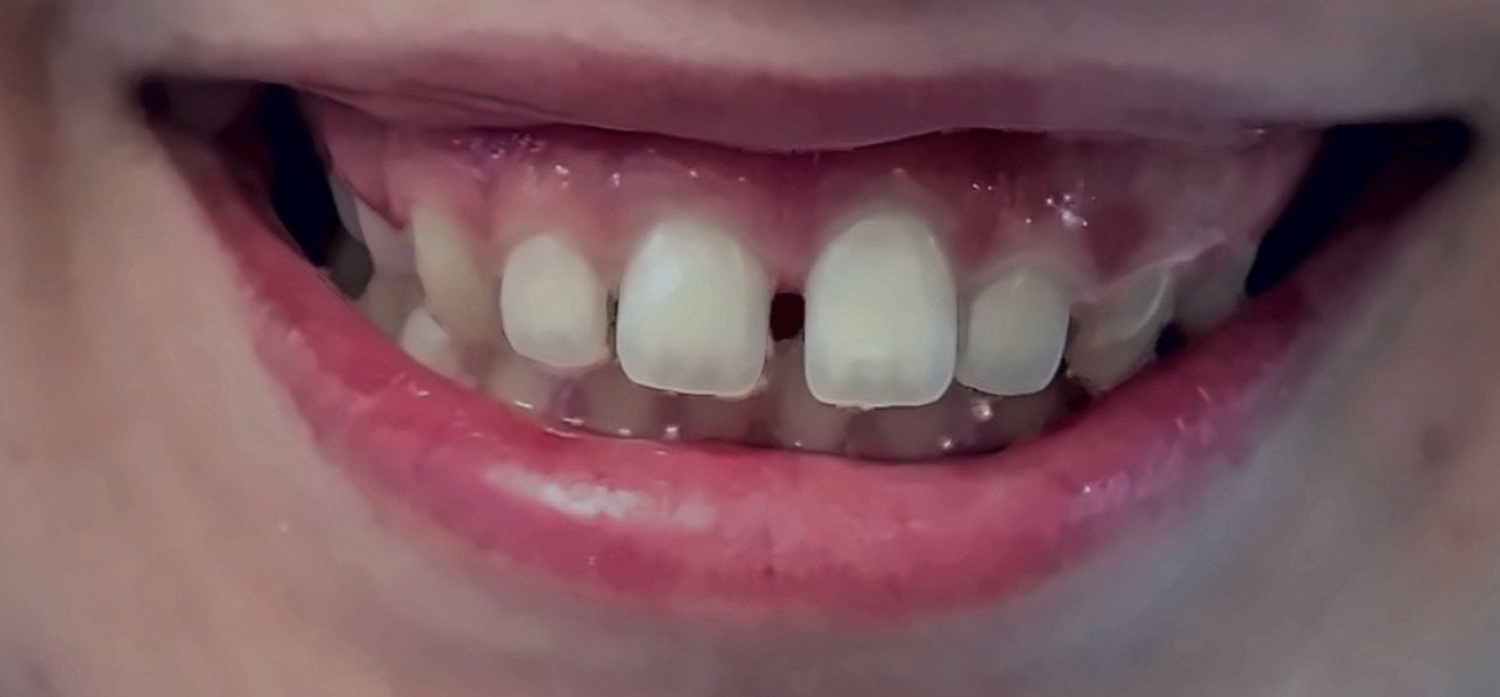 Before treatment at İ-Klinik
