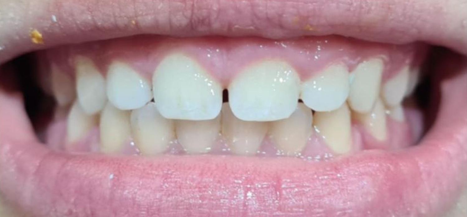 Before treatment at İ-Klinik