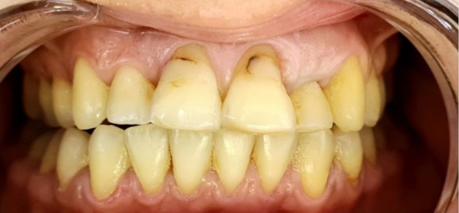 Before treatment at İ-Klinik