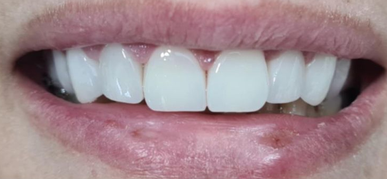 After treatment at İ-Klinik