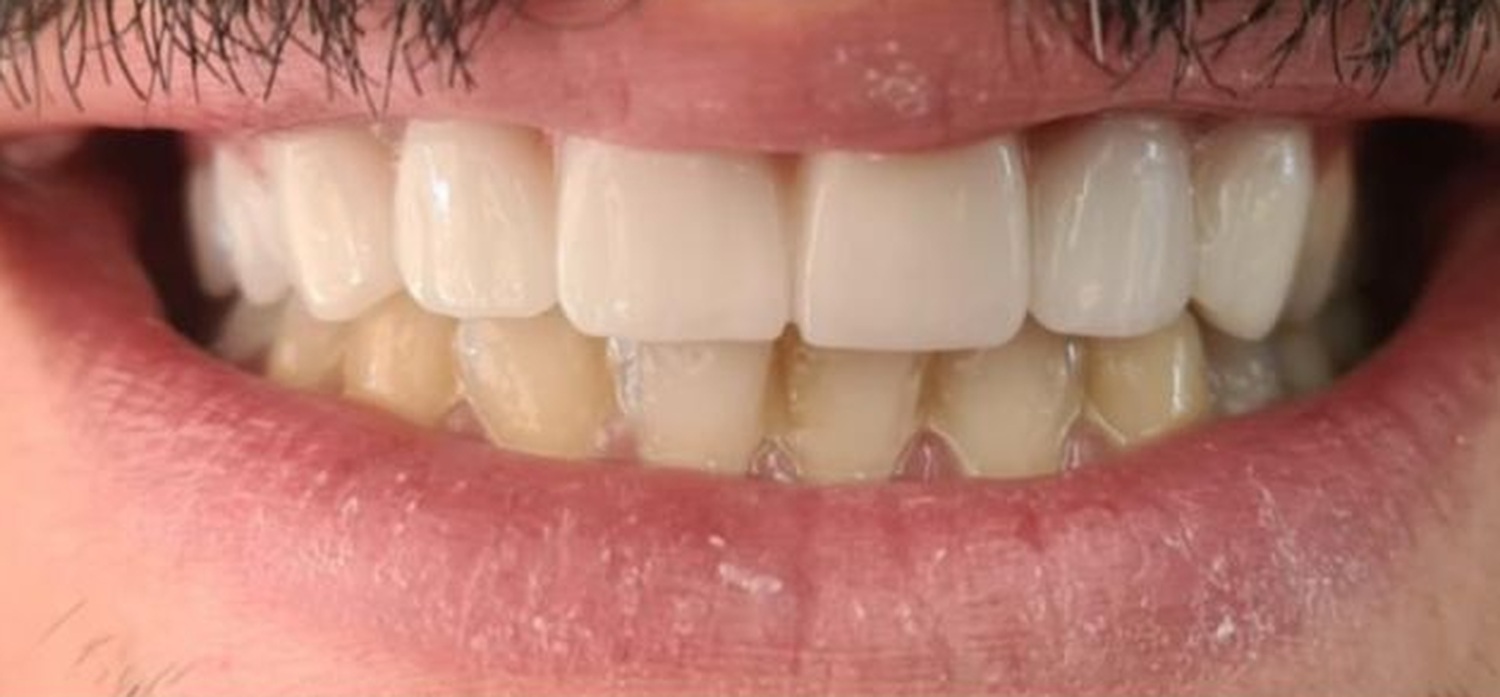 After treatment at İ-Klinik