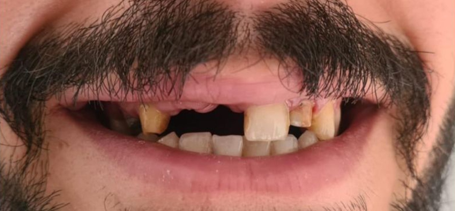 Before treatment at İ-Klinik