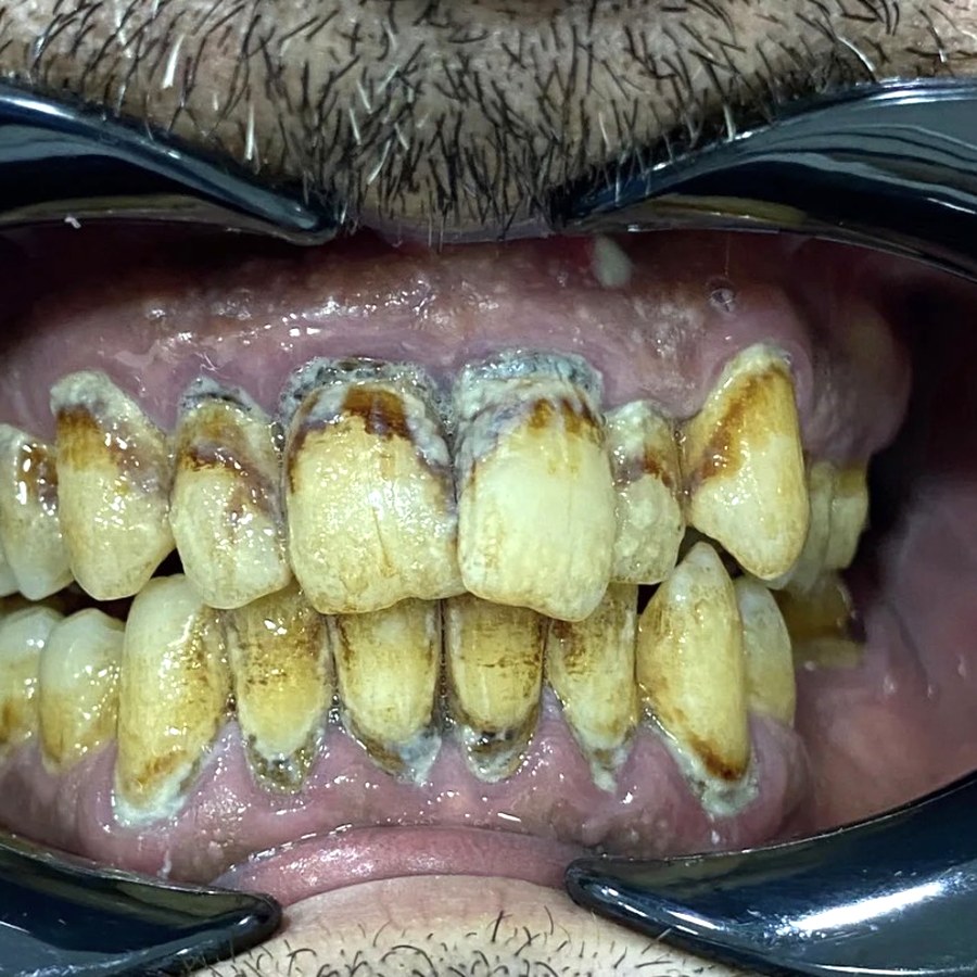 Before treatment at İ-Klinik