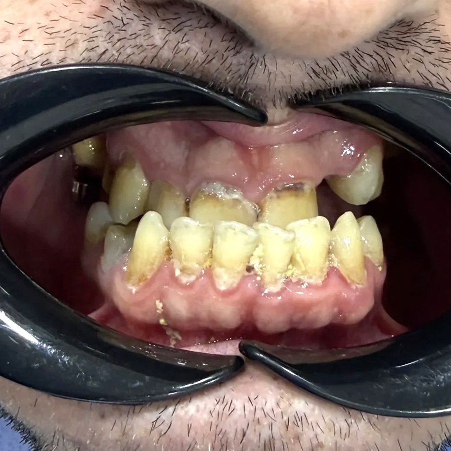 Before treatment at İ-Klinik